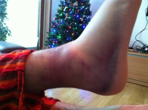 bruised ankle